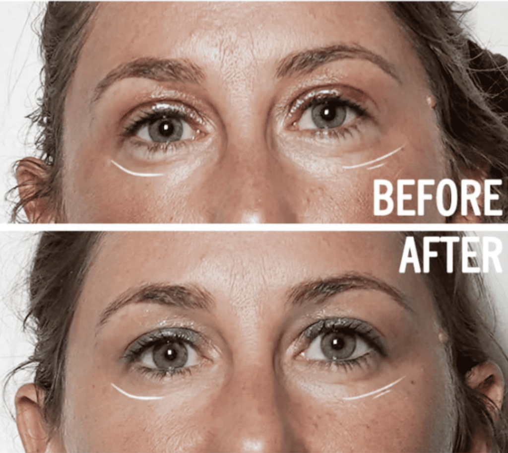 comparaison face lift